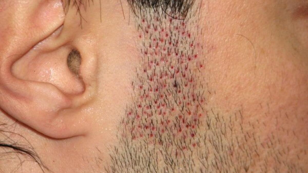 hair transplant sideburns