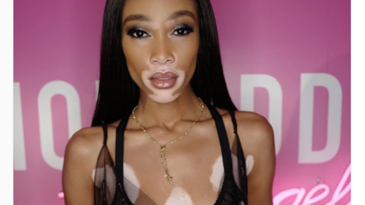 أُصيبت عارضة الأزياء "ويني هارلو" بمرض البهاق فظهرت أصباغ عديمة اللون في العديد من أجزاء جسدها، لكنها اليوم  الوجه الدعائي لكبرى الشركات في عالم الموضة والمكياج