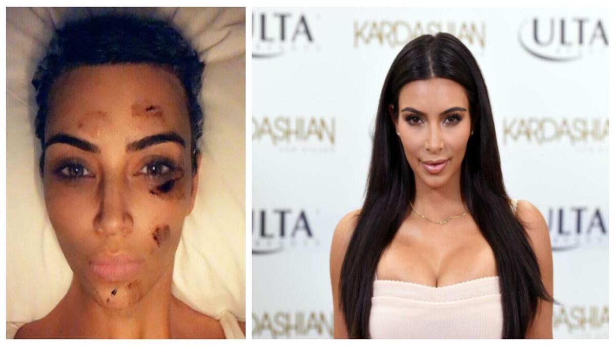 كيم كارداشيان: سيكون من الصعب تصديق أن شخصًا مروجًا للجمال الخارجي يعاني من مرض جلدي نادر.  كشفت بأنها تكافح مرض الصدفية منذ عام 2011 وكثيرًا ما تحدثت عنه في المقابلات ووسائل التواصل الاجتماعي.