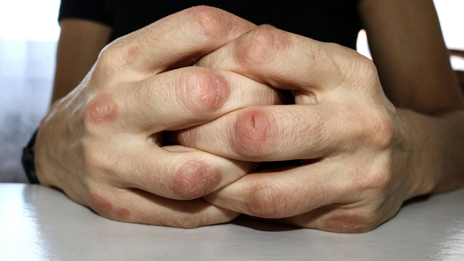 هل تؤثر طقطقة الأصابع والرقبة على