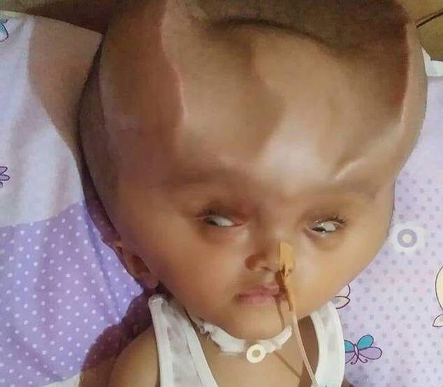 Baby Born With Rare Brain Condition Leaves Him With 'Misshapen' Skull