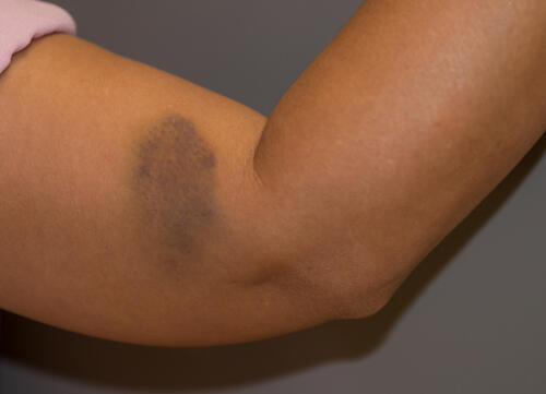 8 أسباب لظهور الكدمات في الجسم البوابة