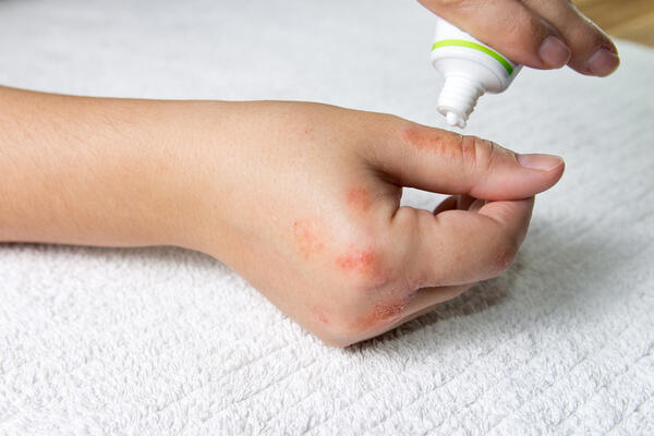 نصائح هامة لبوابة مريض الأكزيما