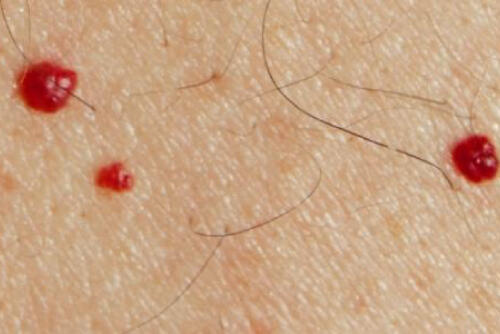 8 أسباب لظهور نقط حمراء على الجلد البوابة
