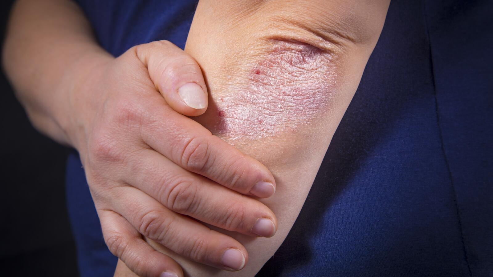 العلاجات المبتكرة تساعد في السيطرة على الصدفية البوابة