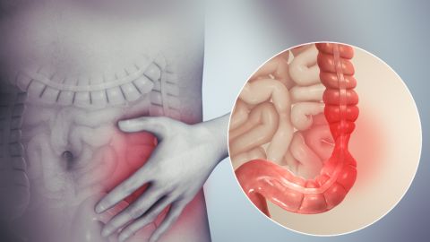 طبيب البوابة: شهر التوعية بمتلازمة القولون العصبي