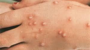 روسيا تعلن عن عقار لجدري القرود