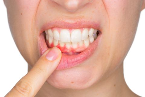 ما علاقة التهاب اللثة بالإصابة بمرض السرطان؟